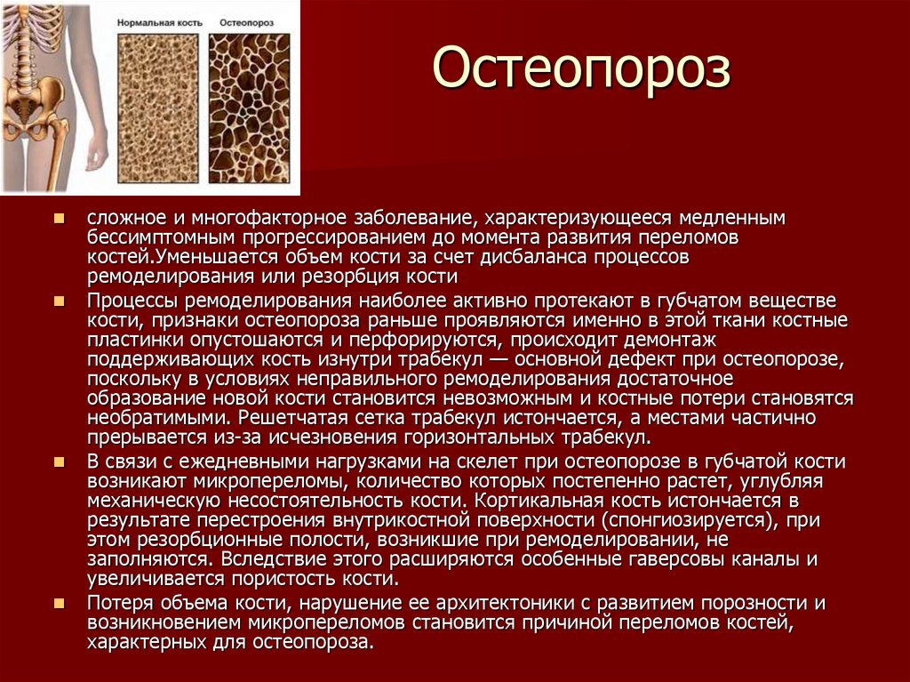 Остеопороз что это и как опасно: Остеопороз – симптомы, лечение .