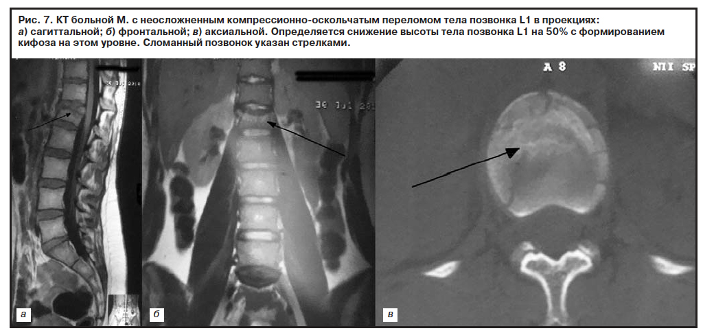 Компрессионный перелом тела 1 1. Компрессионно оскольчатый перелом позвоночника кт. Компрессионный оскольчатый перелом позвоночника l1. Оскольчатый перелом тела позвонка на кт. Оскольчатый перелом позвоночника рентген.