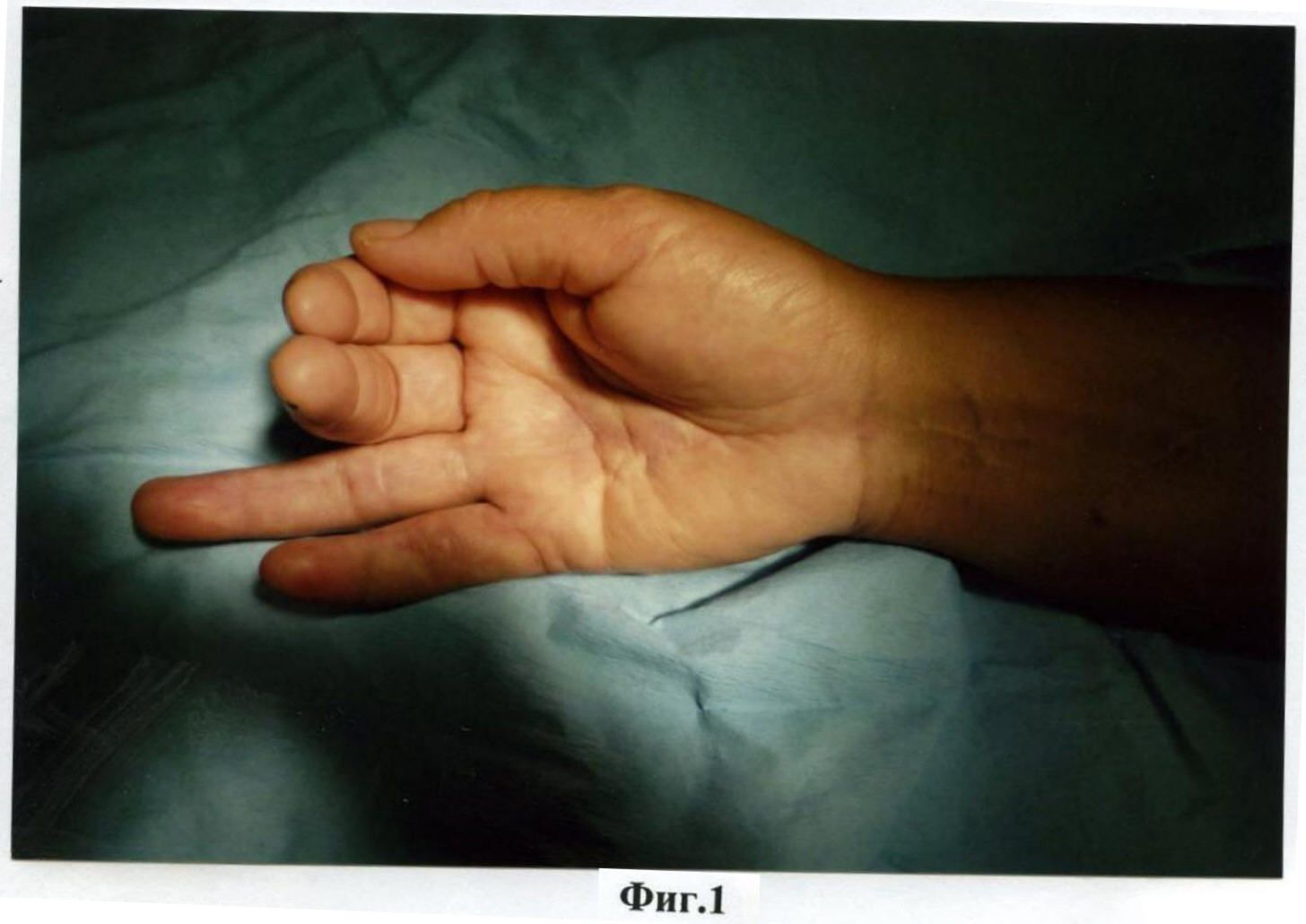 2 пальца на запястье. Ревматоидный артрит кистей пальцев рук. Искривление пальцев рук.