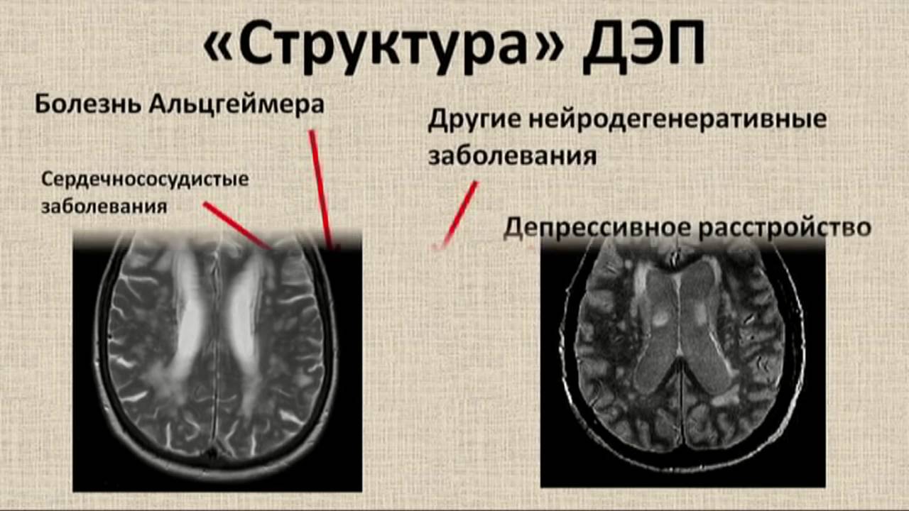 Энцефалопатия на фоне церебрального атеросклероза