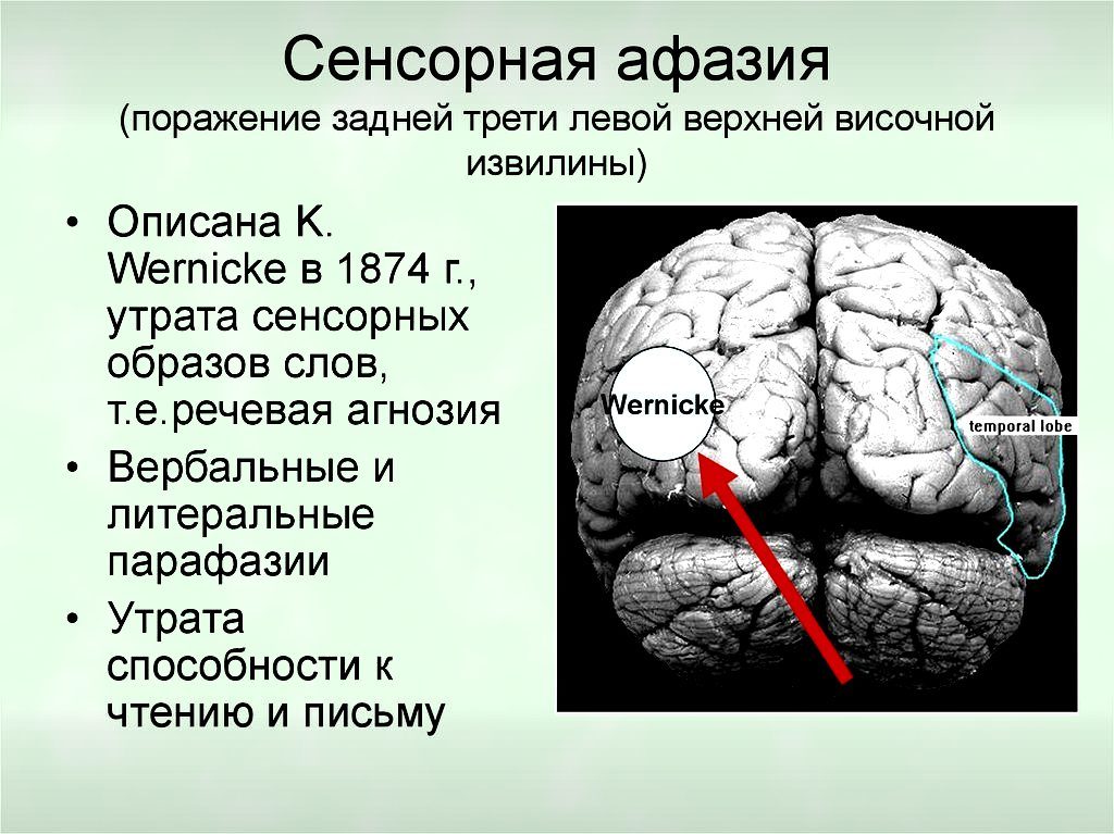 Левое полушарие мозга инсульт. Зона Брока и Вернике афазия. Афазия сенсорная моторная динамическая. Моторная афазия сенсорная афазия амнестическая. Задняя треть верхней височной извилины.