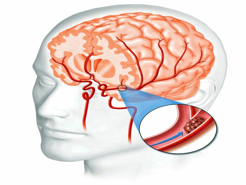 Brain 80. Артериальная гипертензия и инсульт. Сосудистые заболевания головного мозга у детей причины.
