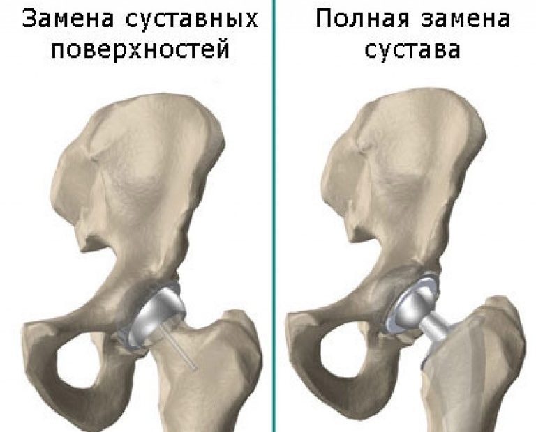 Фото после замены тазобедренного сустава