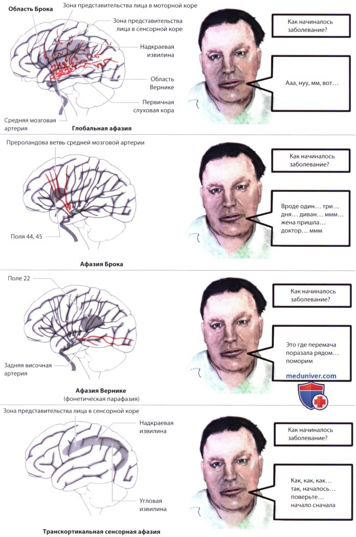 Динамическая афазия картинка