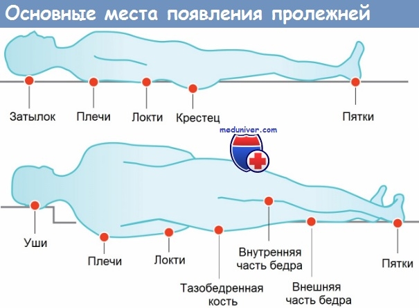 Пролежни на ягодицах фото лечение