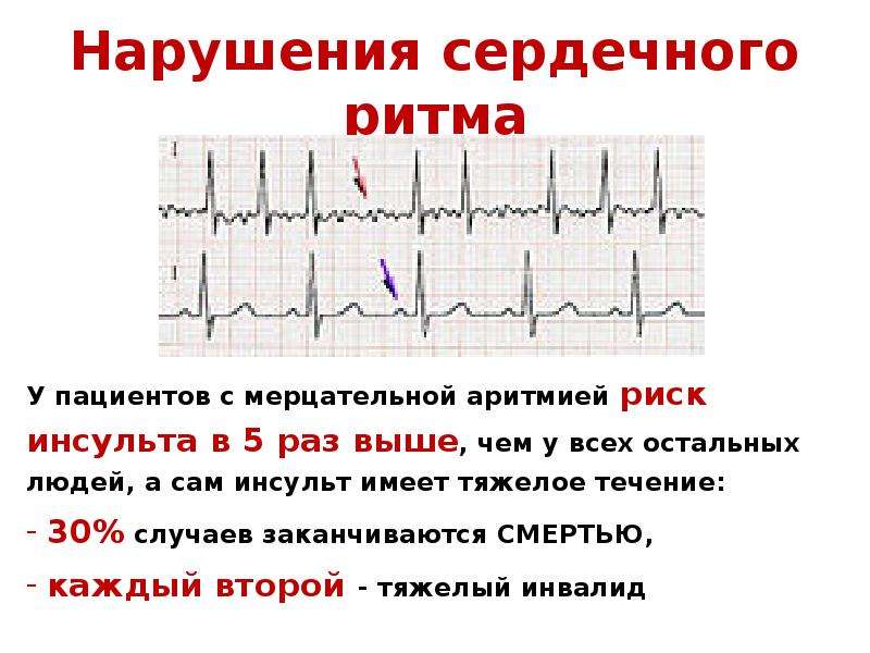 Мерцательная аритмия на фоне стресса