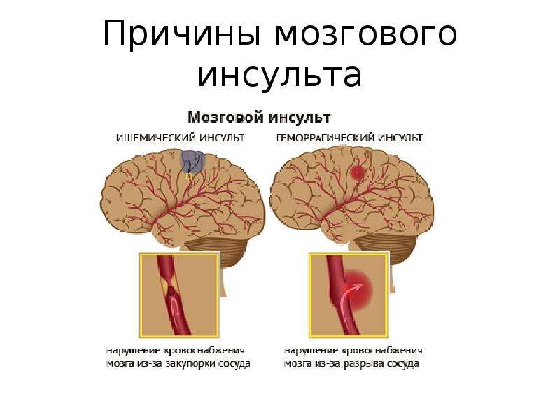 Перекос лица при инсульте фото