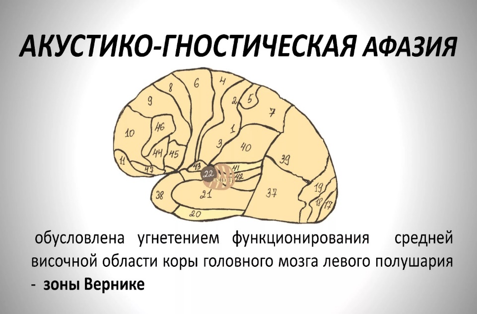 Характеристика афферентной моторной афазии