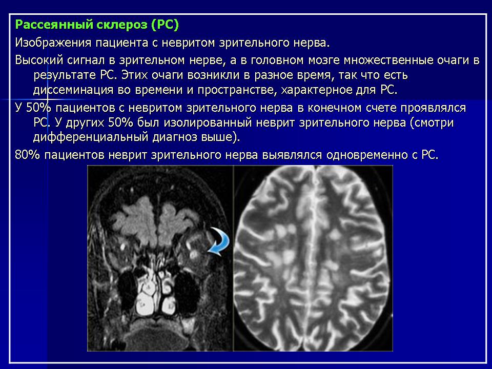 Склероз мозга симптомы