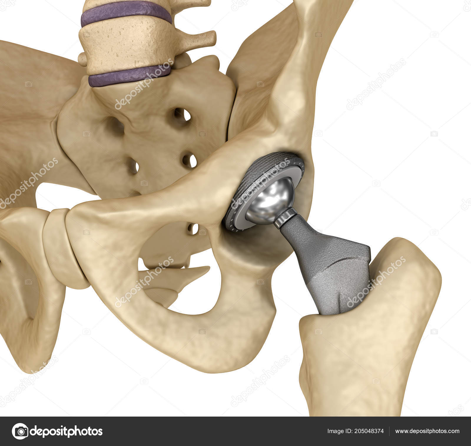 Имплант тазобедренного сустава фото