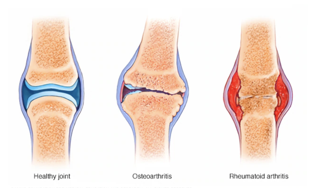 Ревматоидный артрит суставы. Ревматоидный артрит колена. Ревматоидный артрит и остеоартроз. Что разрушает суставы