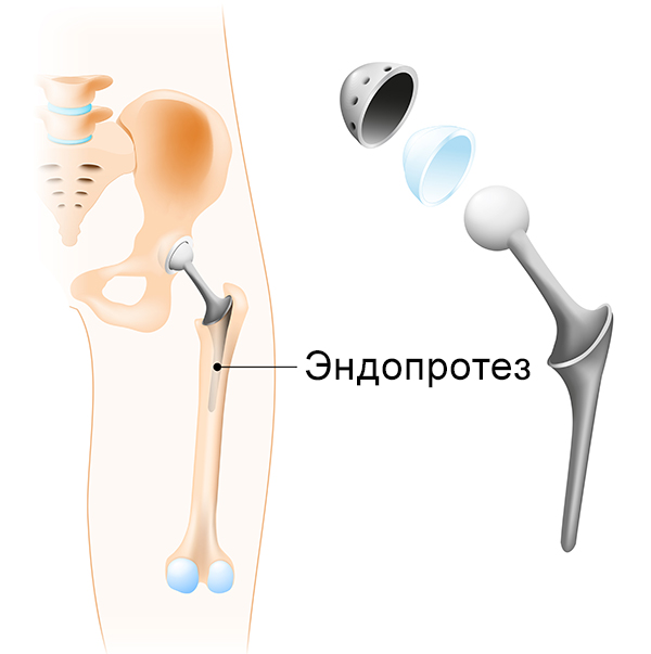 Замена тазобедренного сустава картинки